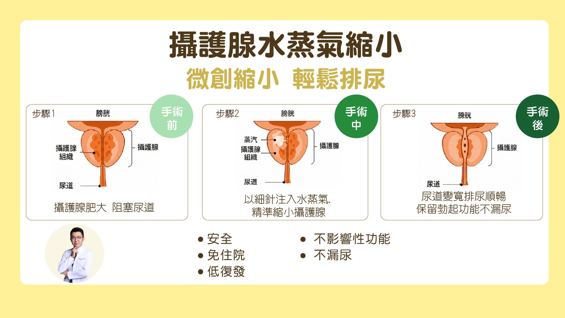 Rezum水蒸氣消融術是什麼?