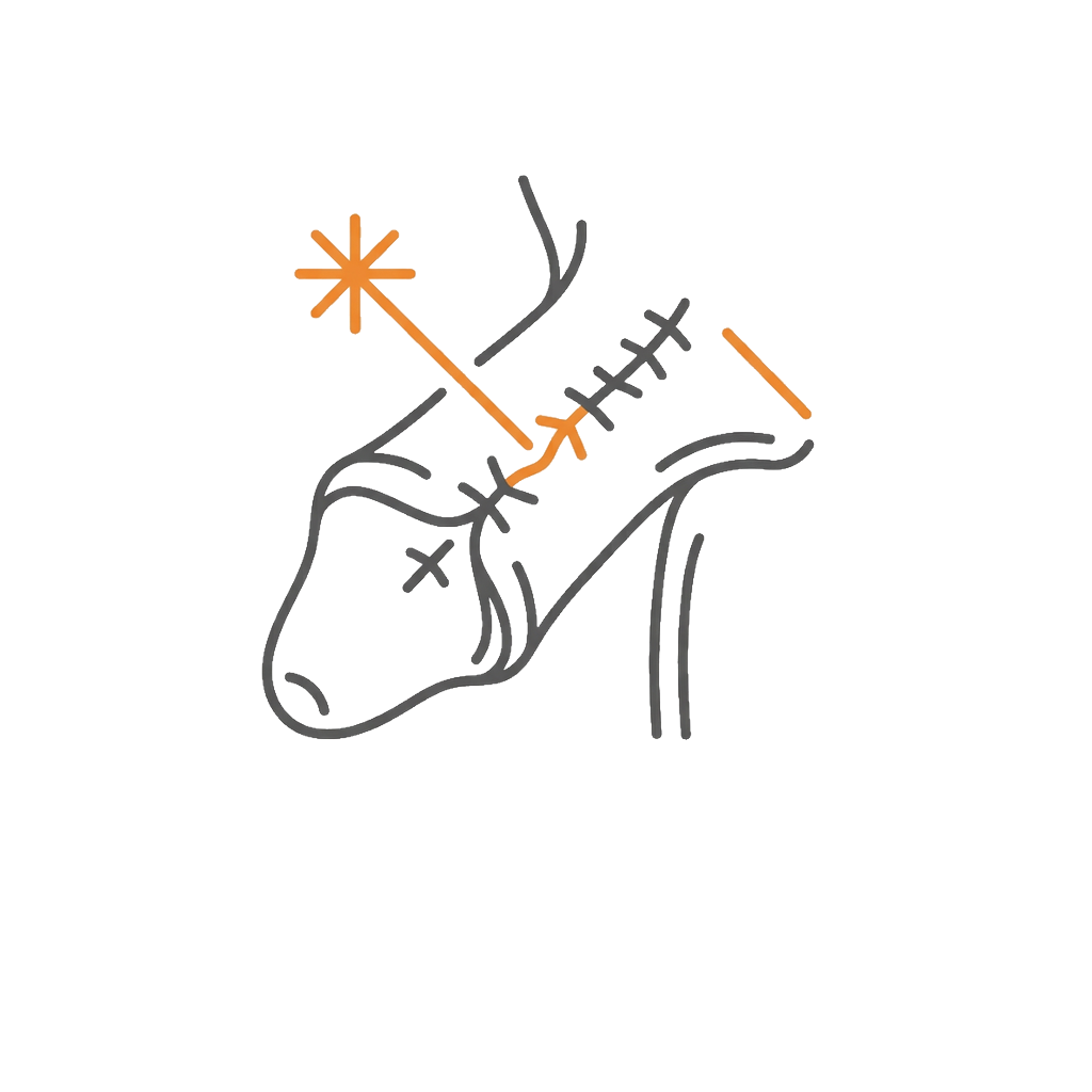 純雷射包皮筋膜摺疊手術