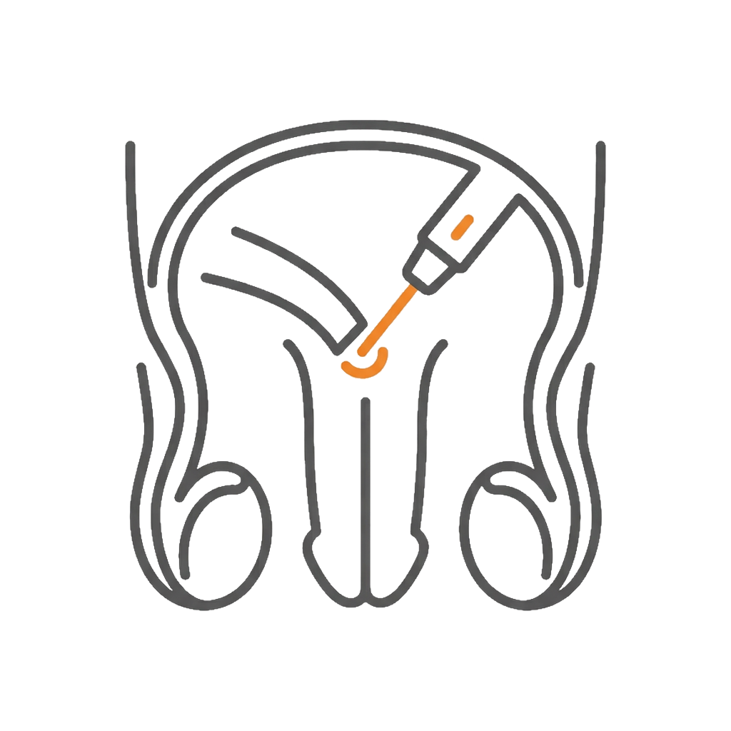 雷射微型創男性結紮手術