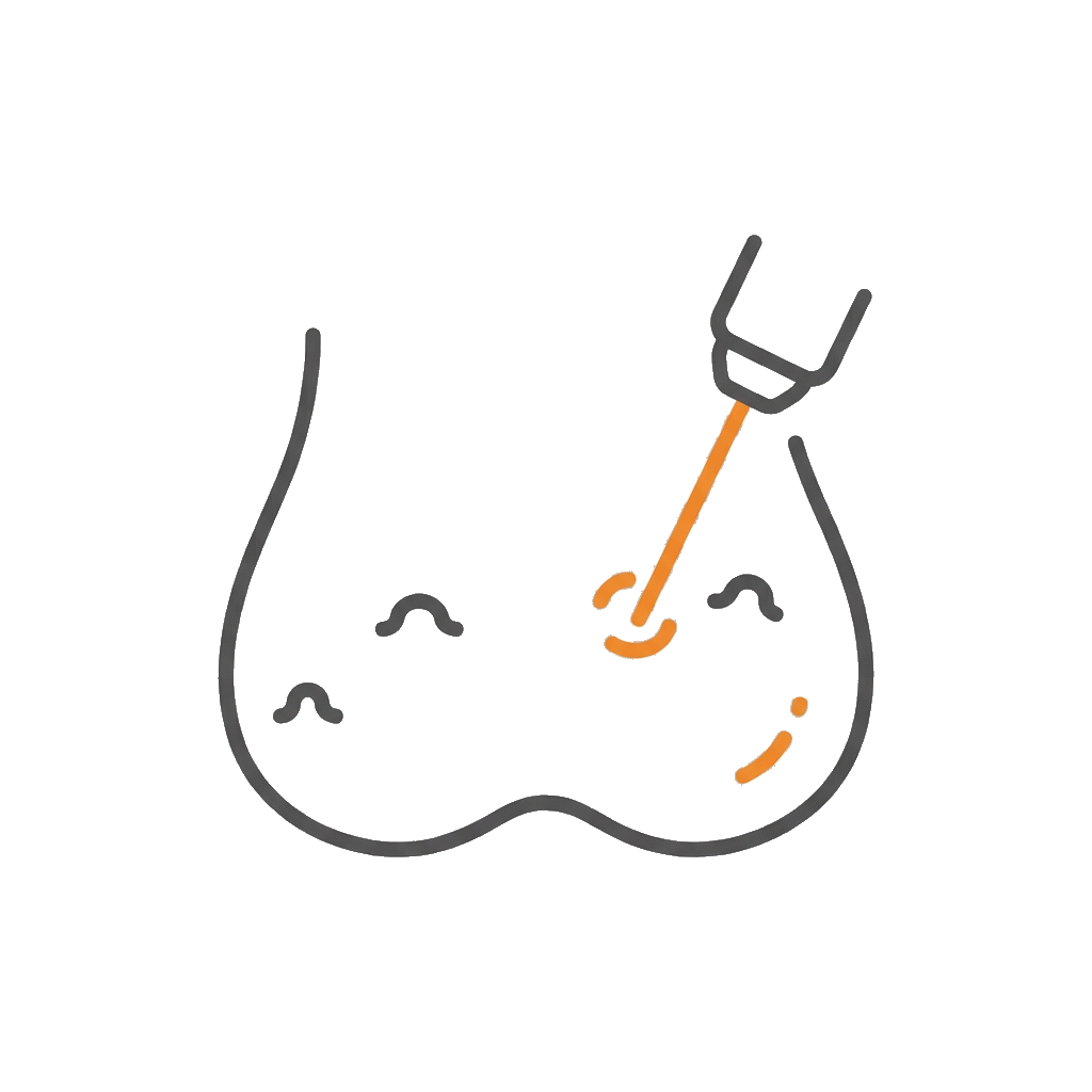 陰囊血管角化瘤雷射