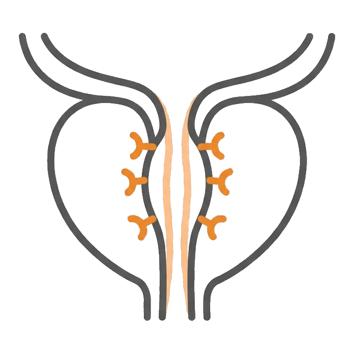 UroLift 攝護腺拉提